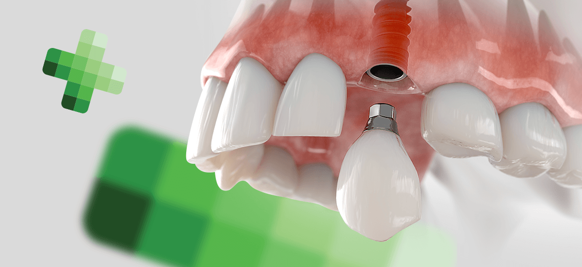 Dental Implants